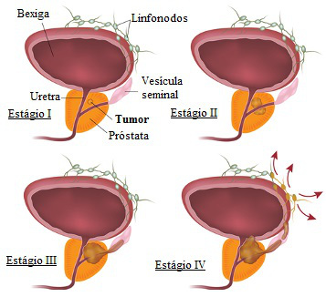 Esquema ilustrativo representando a evolução do câncer de próstata