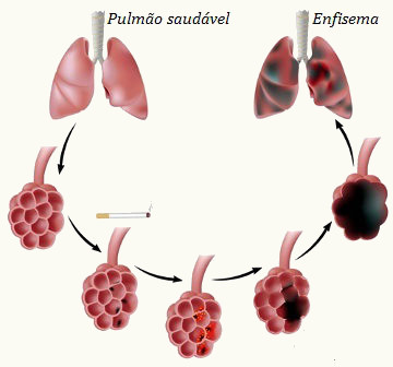 Observe a formação do enfisema pulmonar