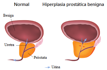Representação pictográfica de uma próstata normal e outra aumentada devido à hiperplasia protática benigna