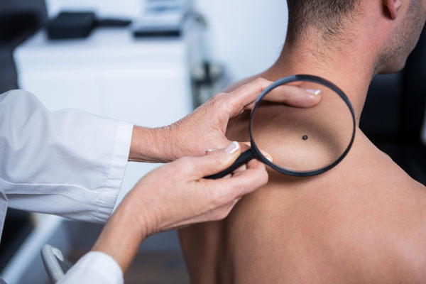 O diagnóstico precoce do câncer de pele é fundamental para o sucesso do tratamento.