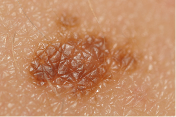 Melanoma – tipo de câncer de pele mais perigoso