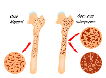 Observe a diferença entre um osso normal e um osso com osteoporose