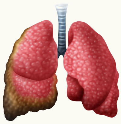 Os pulmões são os órgãos mais atingidos pelas partículas do amianto