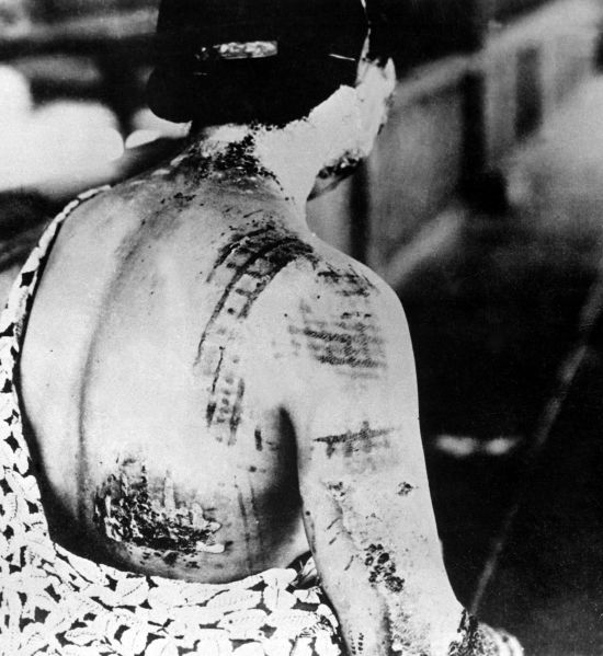 Mulher japonesa com queimaduras resultantes da bomba lançada em Nagasaki
