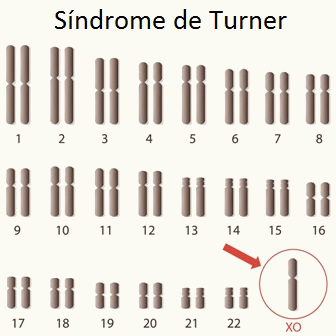 Observe a presença de apenas um cromossomo X